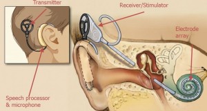 implant graphic